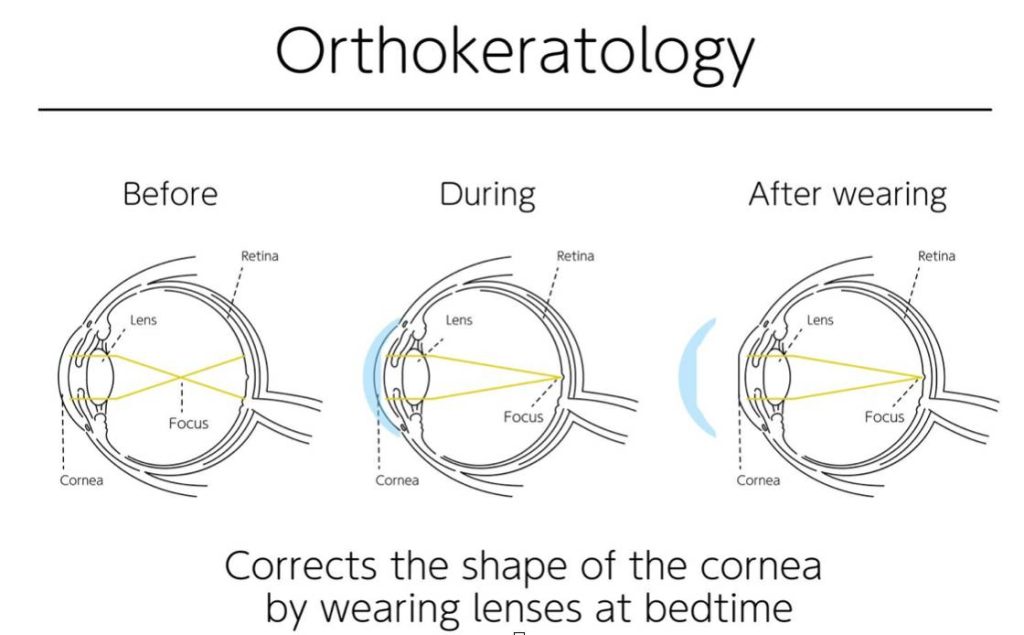 Ortho K at A Plus Optometry